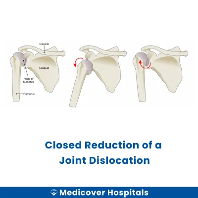 Closed Reduction of A Joint Dislocation