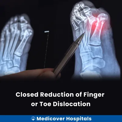 Closed Reduction of Finger Or Toe Dislocation