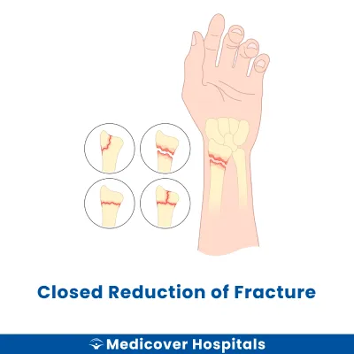 Closed Reduction of Fracture