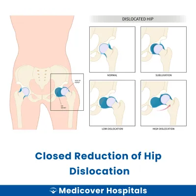 Closed Reduction of Hip Dislocation