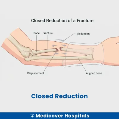 Closed Reduction