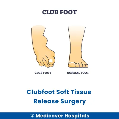 Clubfoot Soft Tissue Release Surgery