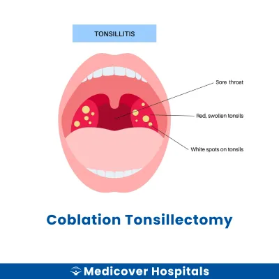 Coblation Tonsillectomy