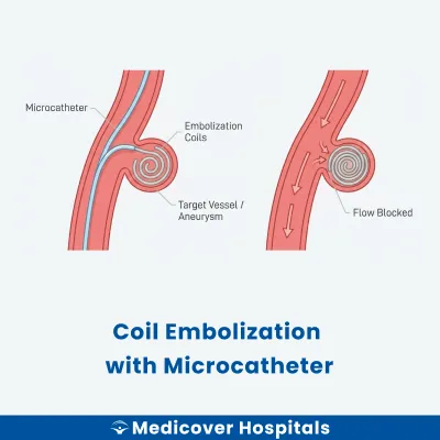 Coil Embolization With Microcatheter