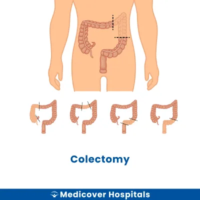 Colectomy