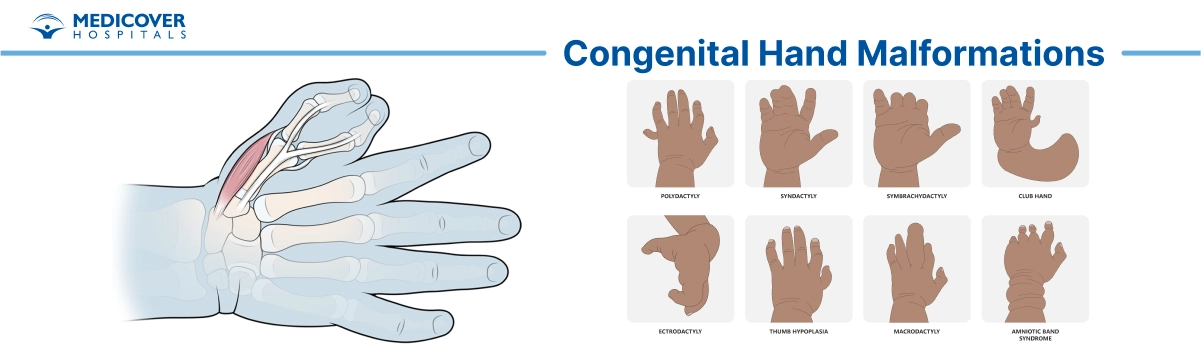 Congenital Hand Malformations Surgery