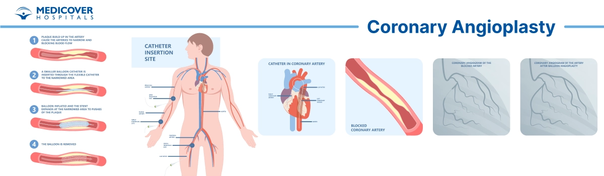 Coronary Angioplasty and Stents Insertion