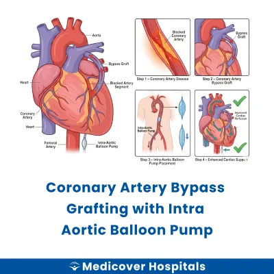Coronary Artery Bypass Grafting With Intra Aortic Balloon Pump