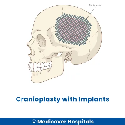 Cranioplasty With Implants