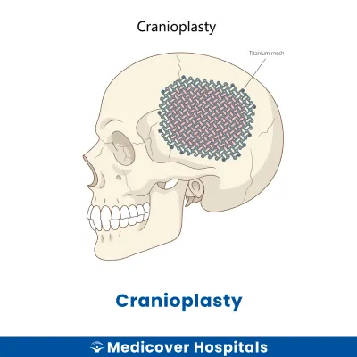 Cranioplasty
