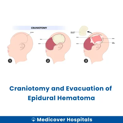 Craniotomy and Evacuation of Epidural Hematoma
