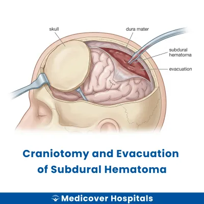 Craniotomy and Evacuation of Subdural Hematoma