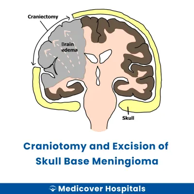 Craniotomy and Excision of Skull Base Meningioma