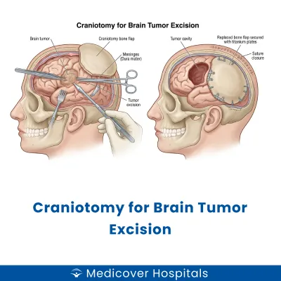 Craniotomy for Brain Tumor Excision
