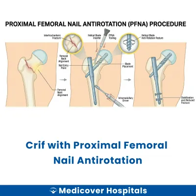 Crif With Proximal Femoral Nail Antirotation