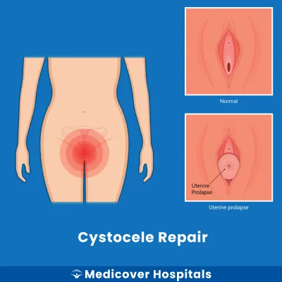 Cystocele Repair