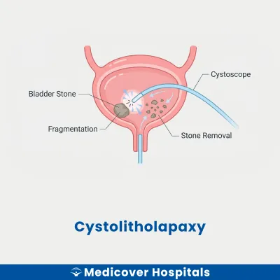 Cystolitholapaxy
