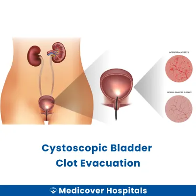 Cystoscopic Bladder Clot Evacuation