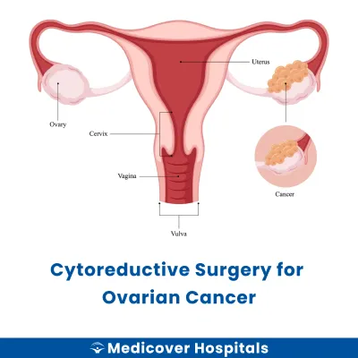 Cytoreductive Surgery for Ovarian Cancer
