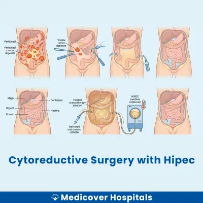 Cytoreductive Surgery With Hipec