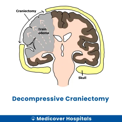 Decompressive Craniectomy