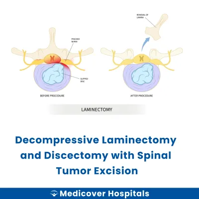 Decompressive Laminectomy and Discectomy With Spinal Tumor Excision