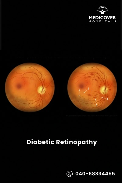 diabetic-retinopathy-procedure