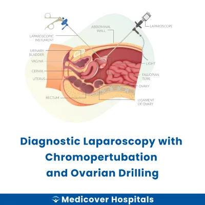 Diagnostic Laparoscopy With Chromopertubation and Ovarian Drilling