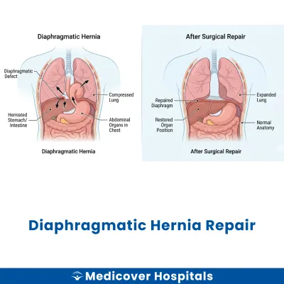 Diaphragmatic Hernia Repair