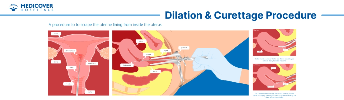 Dilation and Curettage Surgery