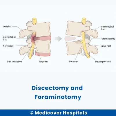 Discectomy and Foraminotomy