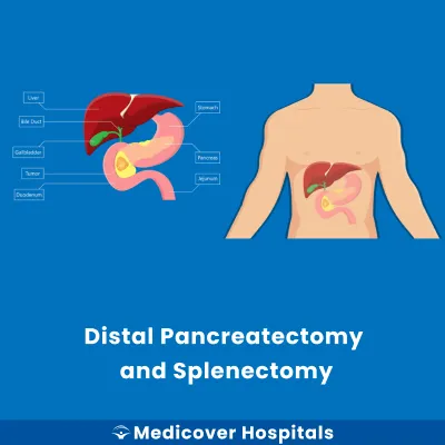 Distal Pancreatectomy and Splenectomy
