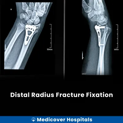 Distal Radius Fracture Fixation