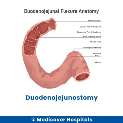 Duodenojejunostomy
