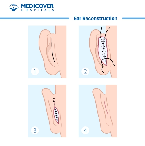 कान का पुनर्निर्माण