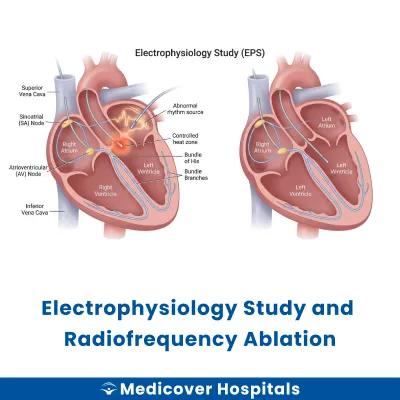 Electrophysiology Study and Radiofrequency Ablation