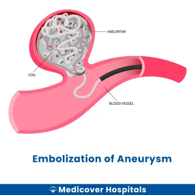 Embolization of Aneurysm