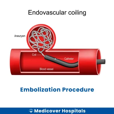 Embolization Procedure