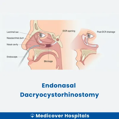 Endonasal Dacryocystorhinostomy