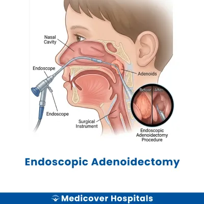 Endoscopic Adenoidectomy