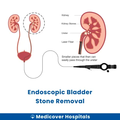 Endoscopic Bladder Stone Removal