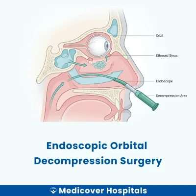 Endoscopic Orbital Decompression Surgery