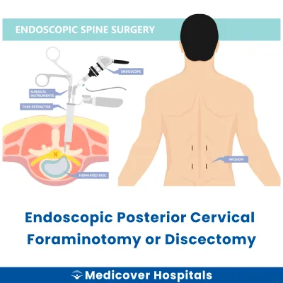 Endoscopic Posterior Cervical Foraminotomy Or Discectomy