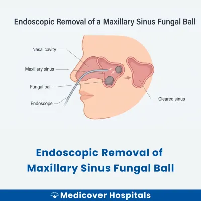 Endoscopic Removal of Maxillary Sinus Fungal Ball