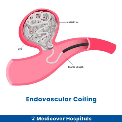 Endovascular Coiling