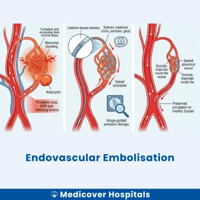 Endovascular Embolisation