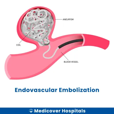 Endovascular Embolization