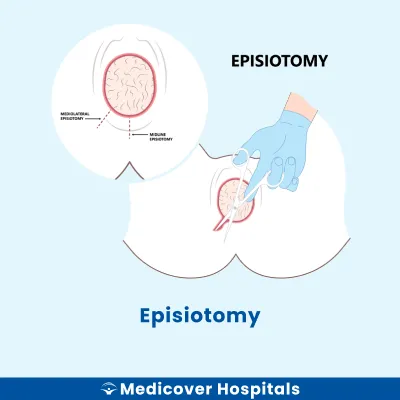 Episiotomy