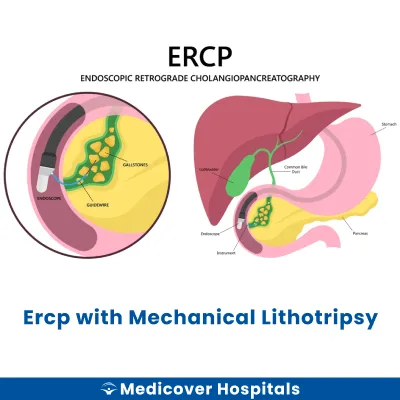Ercp With Mechanical Lithotripsy