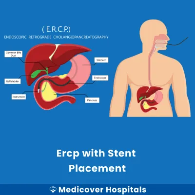 Ercp With Stent Placement